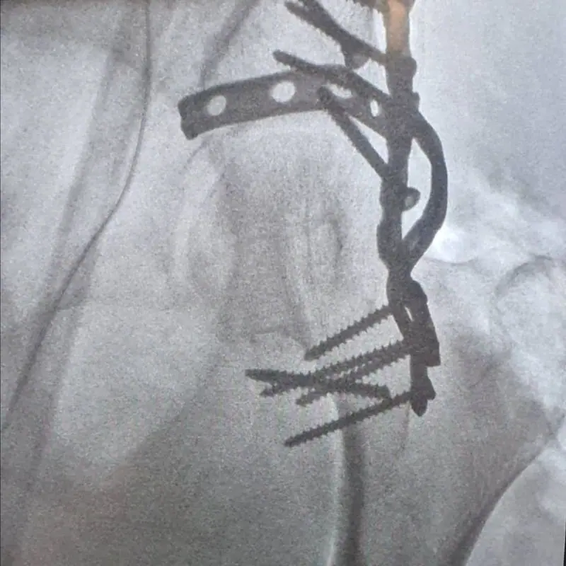 Intra-operative X-ray showing a metal plate and screws fixing the pelvis