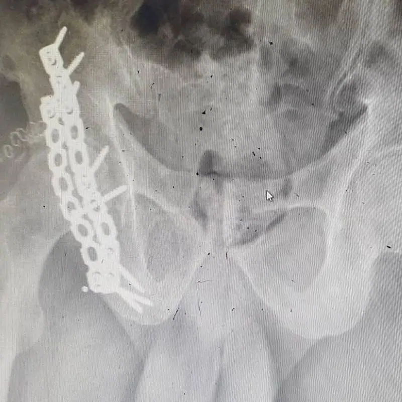 X-ray of the pelvis with a fixation plate